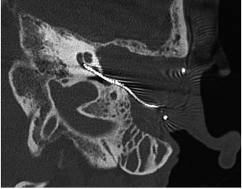 Cochlear Implant Electrode Migration due to Cholesterol Granuloma: Cues from a Case
