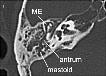 Primary Liposarcoma with Cholesteatoma in Mastoid